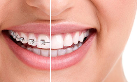 Get rid of Crooked Teeth and Straighten your confidence. at Fine Feather Dental, Ahmedabad